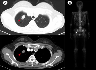 Case Report: Outcome of Osimertinib Treatment in Lung Adenocarcinoma Patients With Acquired KRAS Mutations 